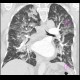 Lung congestion, interstitial edema: CT - Computed tomography